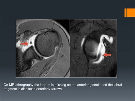 best labral tear test|shoulder labrum tear x ray.